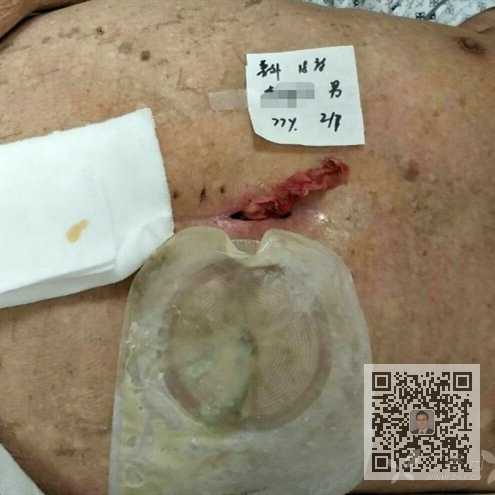 男性患者,77岁,因胃穿孔修补术后切口感染,胃瘘44天入院,近一月间断