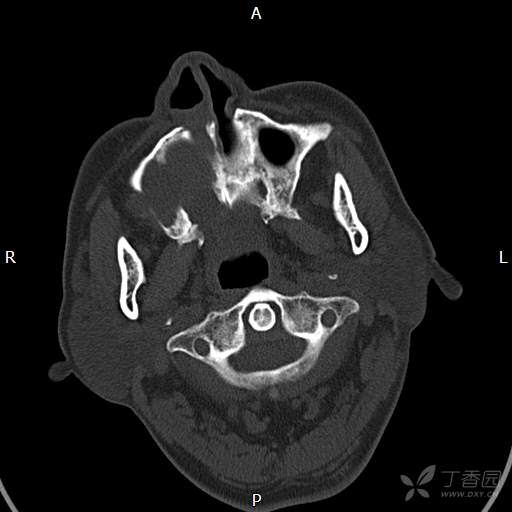 右侧上颌窦占位,右侧颜面部胀痛一年余,男,61岁 - 丁香园论坛