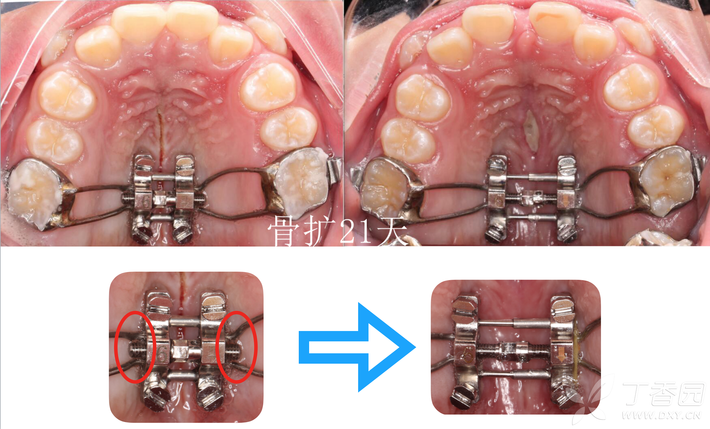 拆除後是情況用tpa,功能矯治器之類穩定擴弓效果.