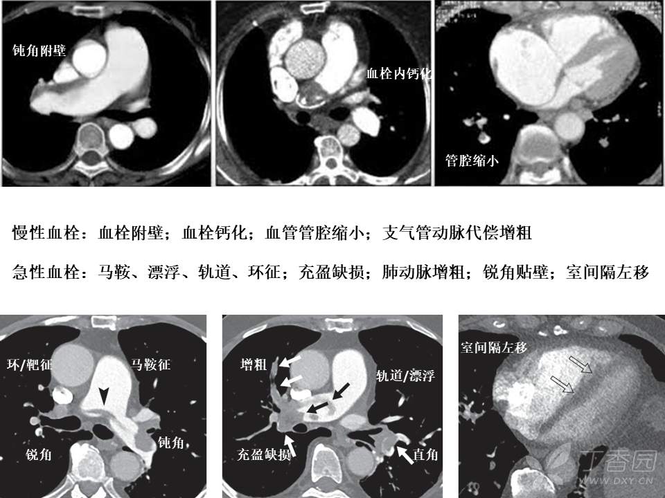 急性肺栓塞 ctpa 直接征象