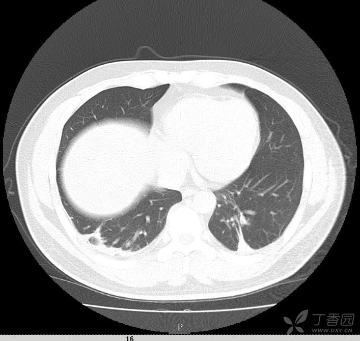 新冠肺炎ct影像图片