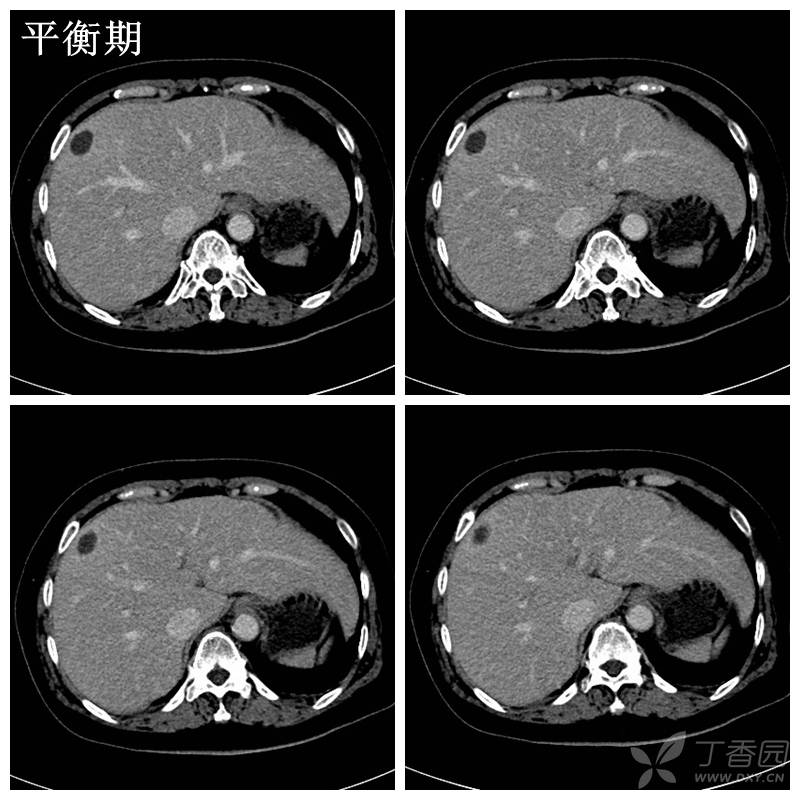 细菌性肝脓肿的ct诊断 - 丁香园论坛