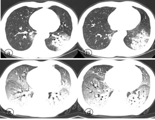 新冠肺炎的肺CT图片图片