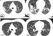 胸部 CT 检查在新冠肺炎诊断中扮演怎样的角色