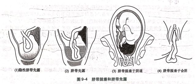 宫颈口展平图片