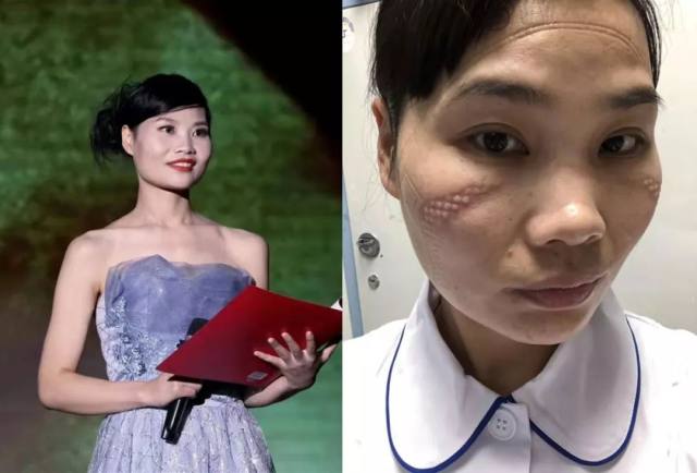 武汉抗疫前线护士摘下口罩后的照片曝光太让人心疼了