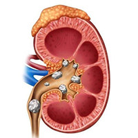 肾结石（RU）动物模型 / 泌尿系统模型