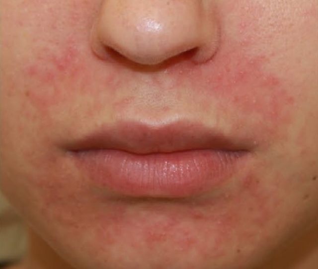 丘疱疹和丘脓疱疹,表面有脱屑(见图 5),有人认为口周皮炎是玫瑰痤疮的