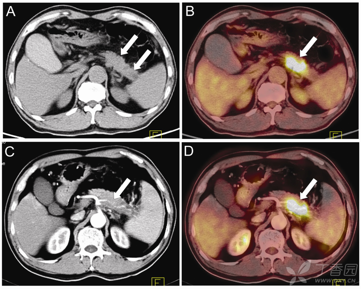 petct在胰腺腫瘤診斷及臨床決策中的價值