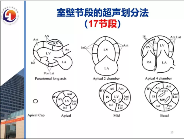 1,室壁节段的超声划分acs 患者超声心动图的典型征象为:静息或负荷