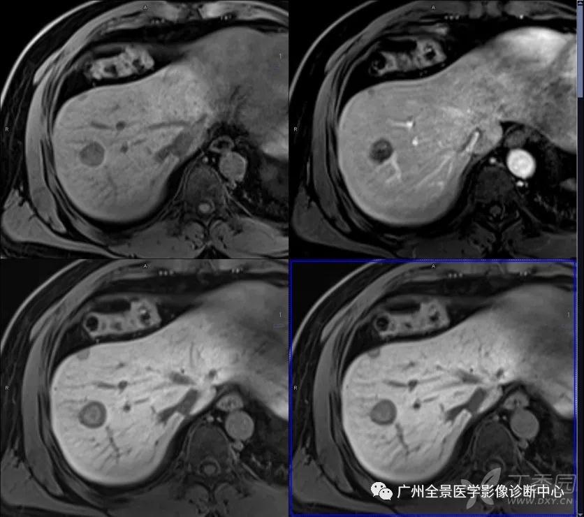 【全景病例】肝右前葉多發異常密度影,考慮肝內多發轉移,pet/mr做