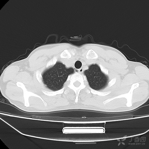 气管憩室,气管插管会引发纵隔气肿吗?