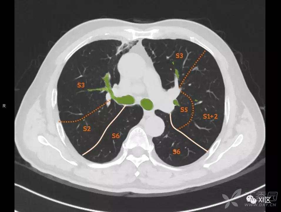 肺的斷層分段示意圖在進行肺的分段時,可以上下觀察瀏覽,沿著相應氣管
