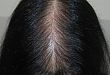 行医笔记：女性型脱发的诊断和治疗