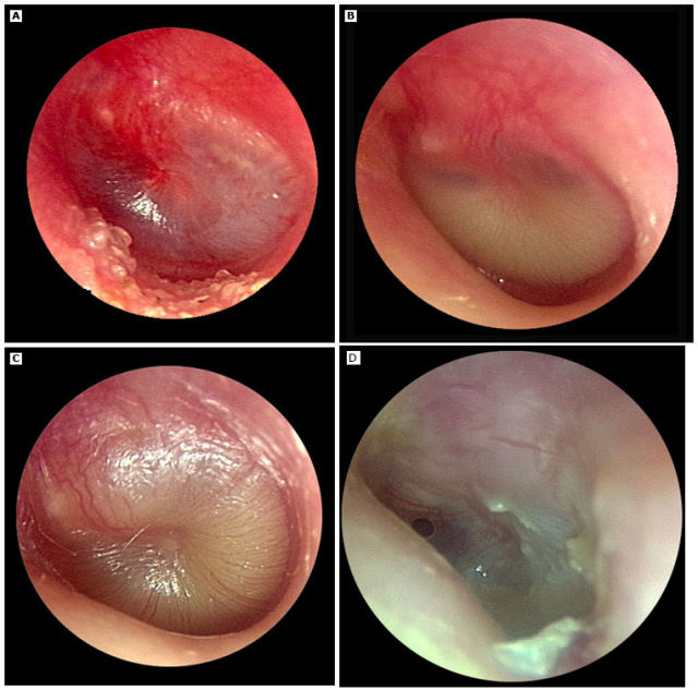 中耳积液.jpg