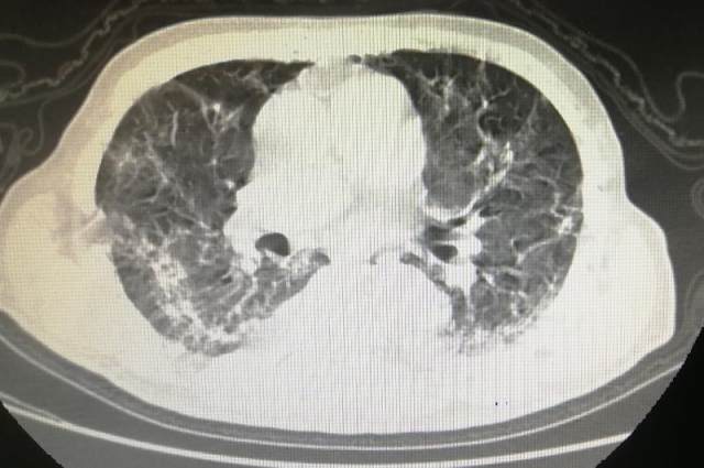 89 岁高龄武大教授与老伴同天痊愈出院