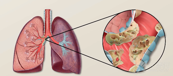 肺不张的病因,临床特征,病理学,病理生理学,诊断和治疗 !-- -->  !