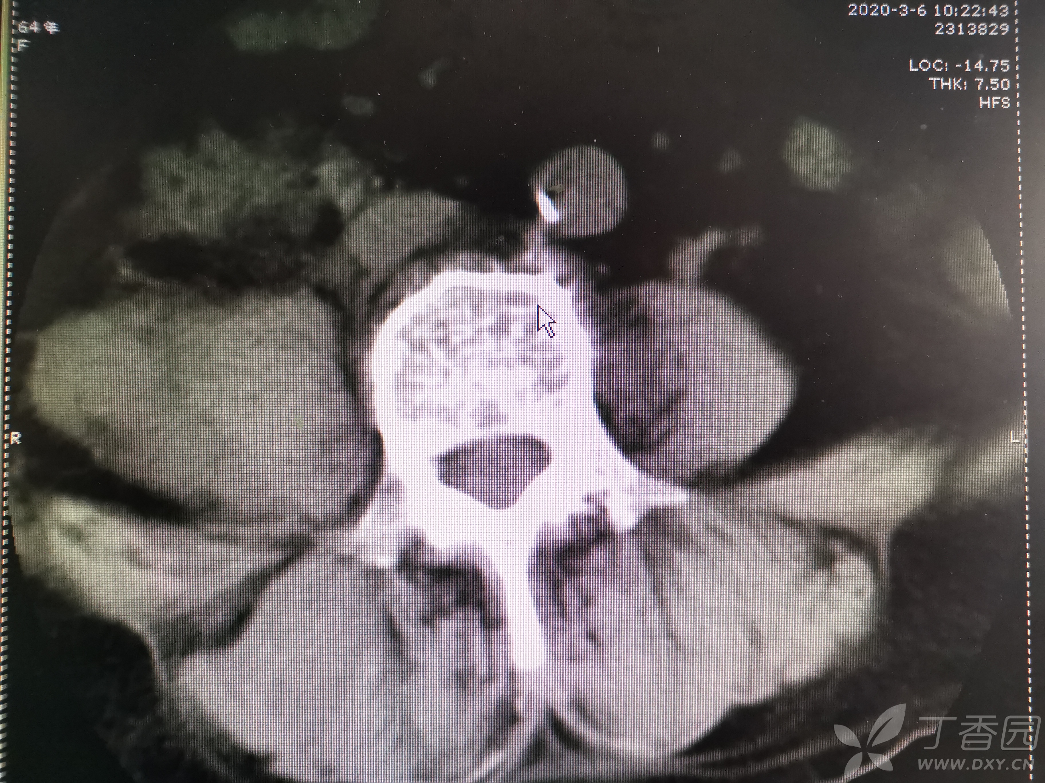 【求助】一例腰大肌脓肿病人的诊治(重点求助下脓肿致病菌的确定及抗
