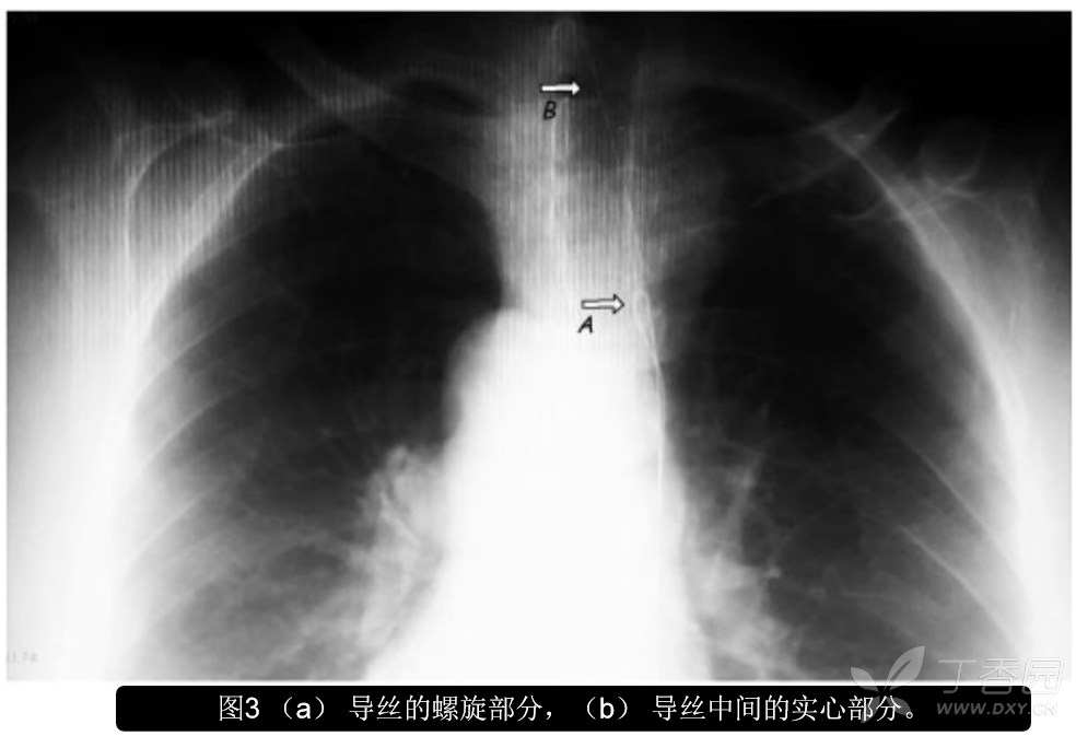 什么是游离端 3402600317459185007-8w.png
