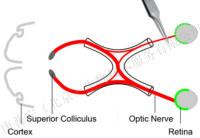 视神经钳夹损伤致青光眼模型（ONC）及药效实验 