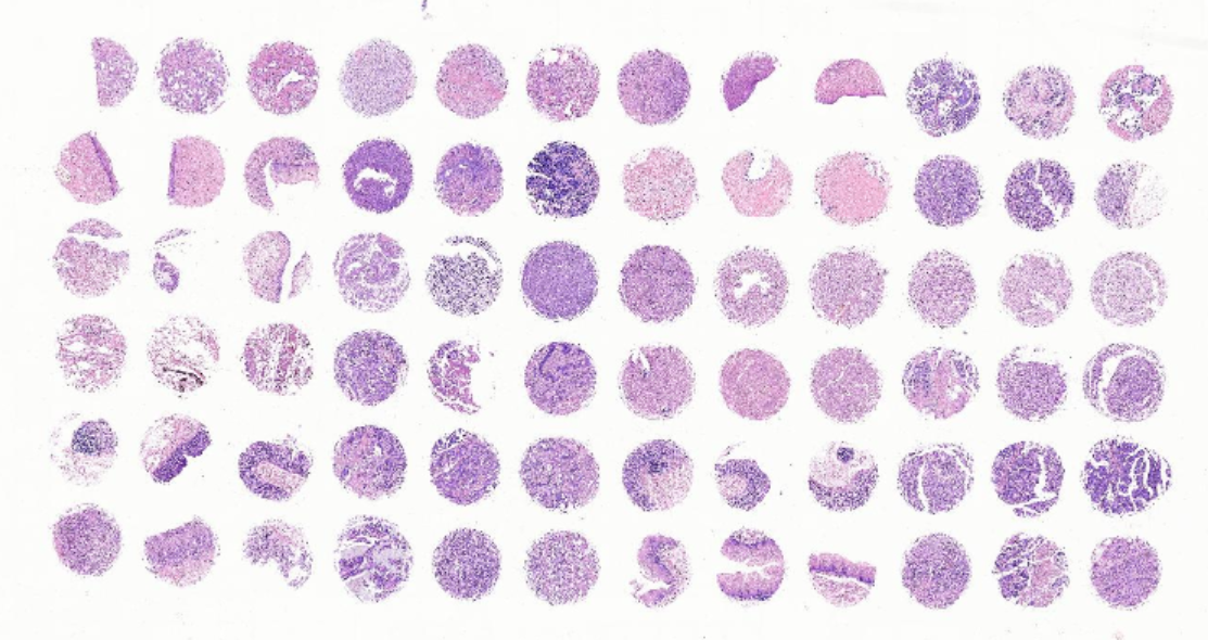 多器官肿瘤和匹配瘤旁组织组合芯片X72Mc01