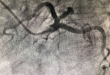 STEMI 合并新型冠状病毒感染管理策略