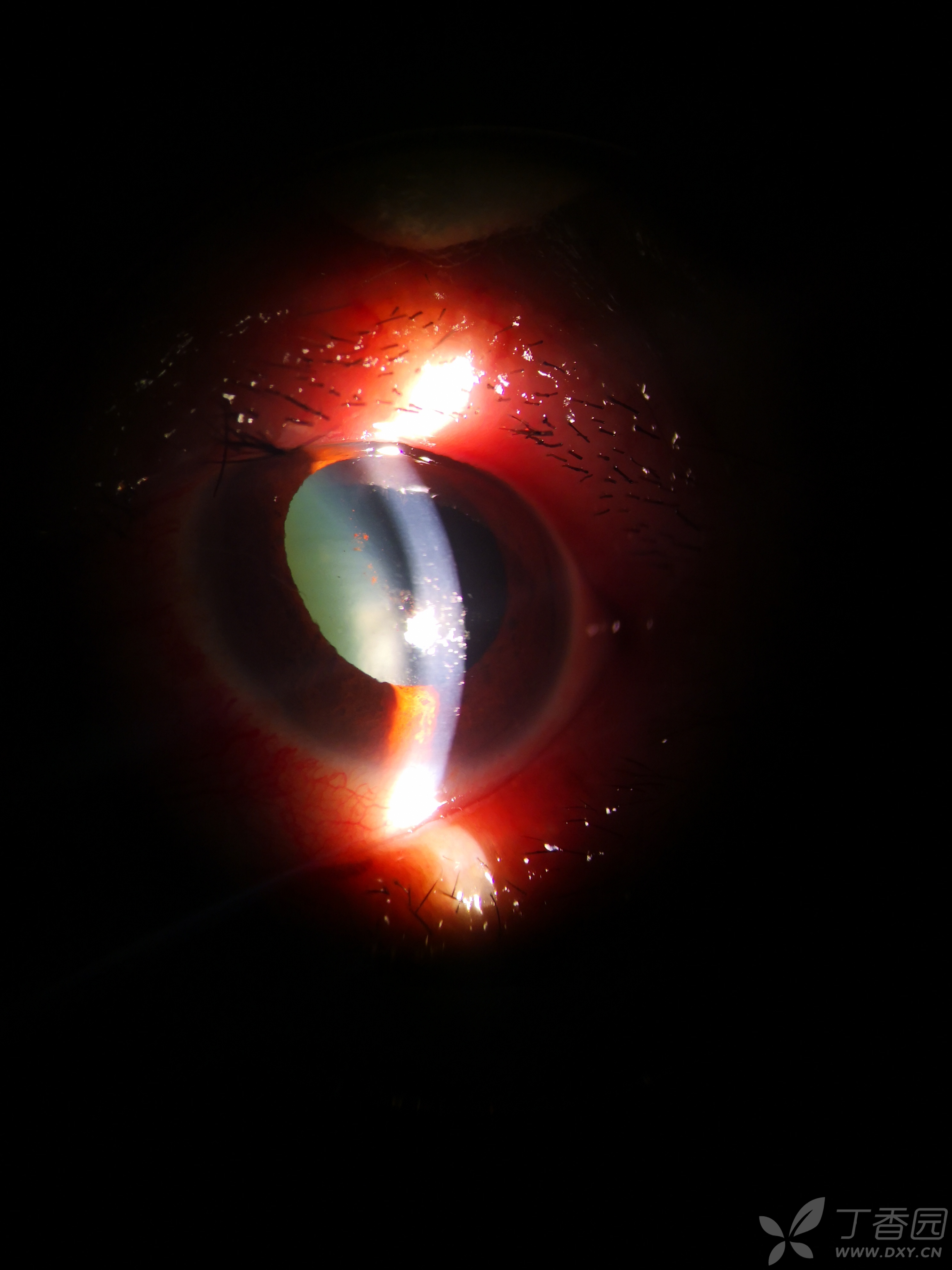 青光眼小梁根切术术后浅前房,低眼压,大神各抒己见,百家争鸣下呗.