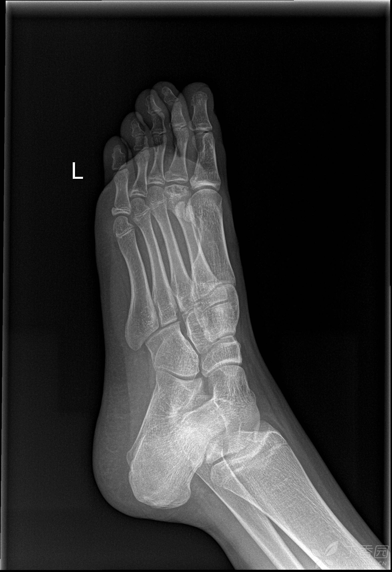 跖骨头缺血坏死补充一例.