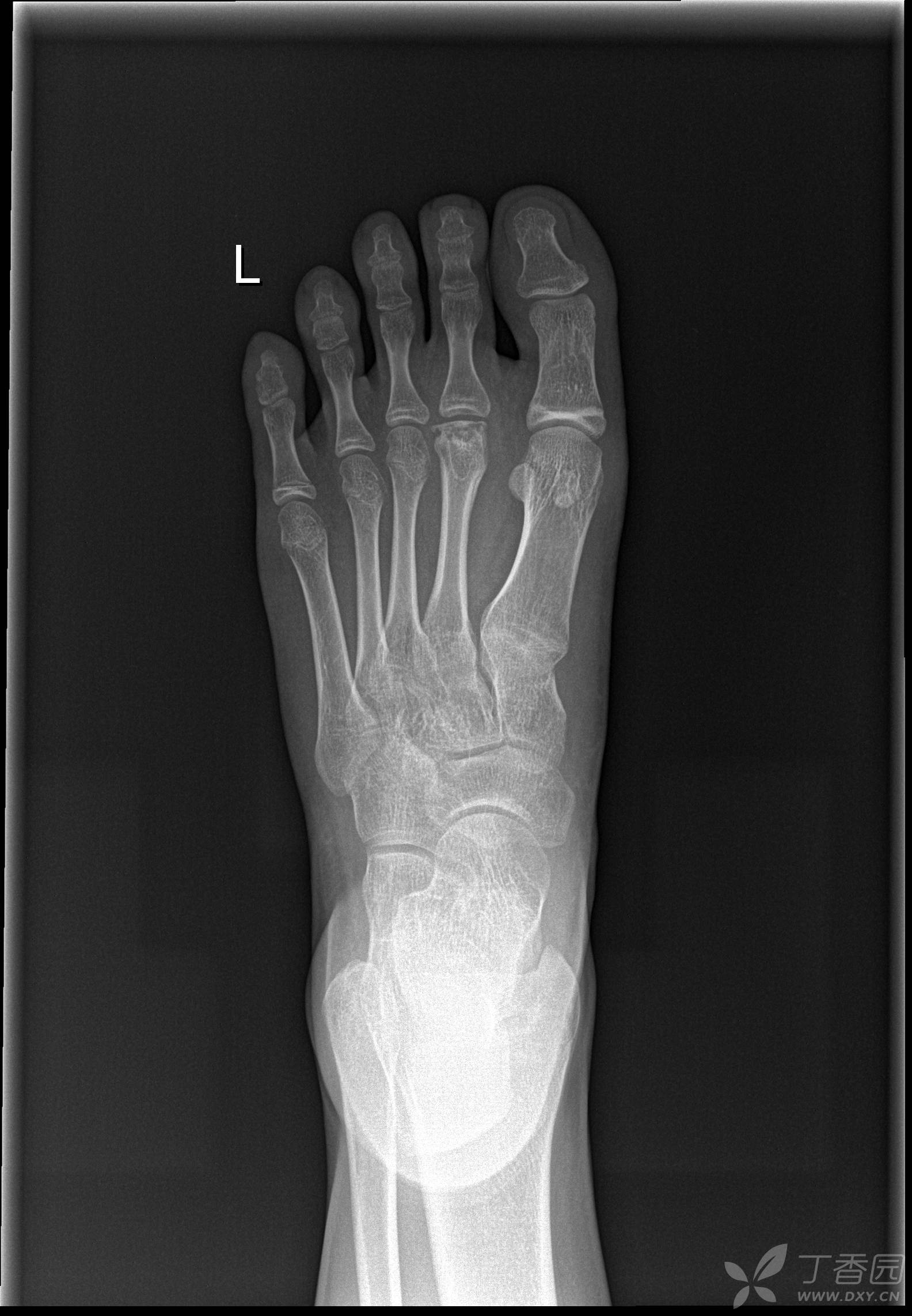跖骨头缺血坏死补充一例.