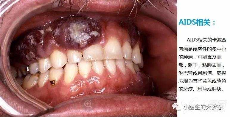 医学经典图片 帖子详情 分类 经典型卡波西肉瘤 是最常见的艾滋病相关