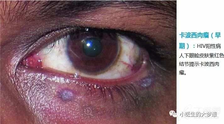 nejm:命根子上长了个这东西,大家一起来看看(结果更新在24楼,25楼)