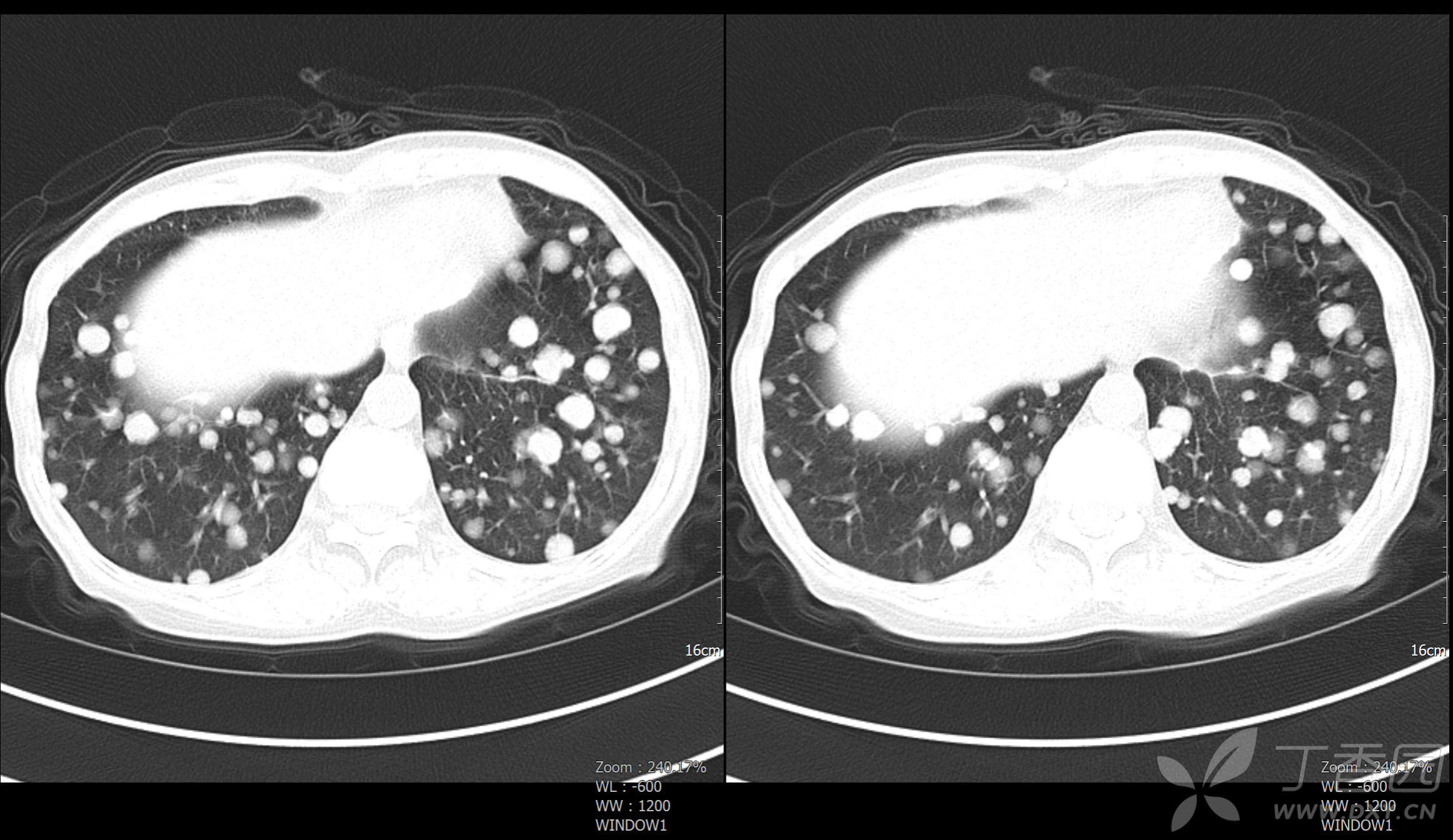 典型病例066:肺癌肺转移,密集恐惧症者忌 - 丁香园论坛