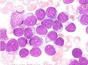 慢性骨髓单核细胞性白血病规格 