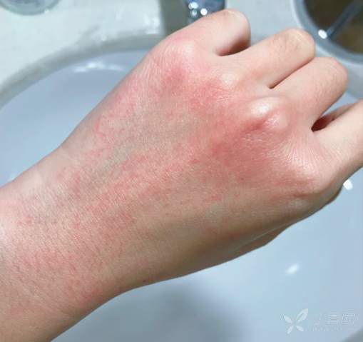 平均每天洗手上百次,洗到脱皮奇痒无比,医护们你的手还好吗?