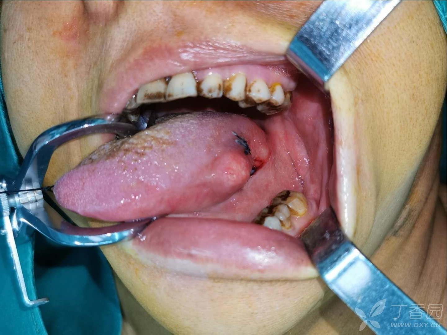 舌骨囊肿刀口图片