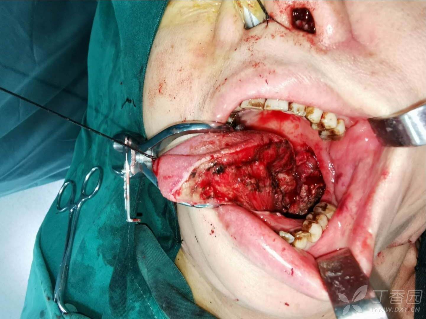 今天做的舌癌手术