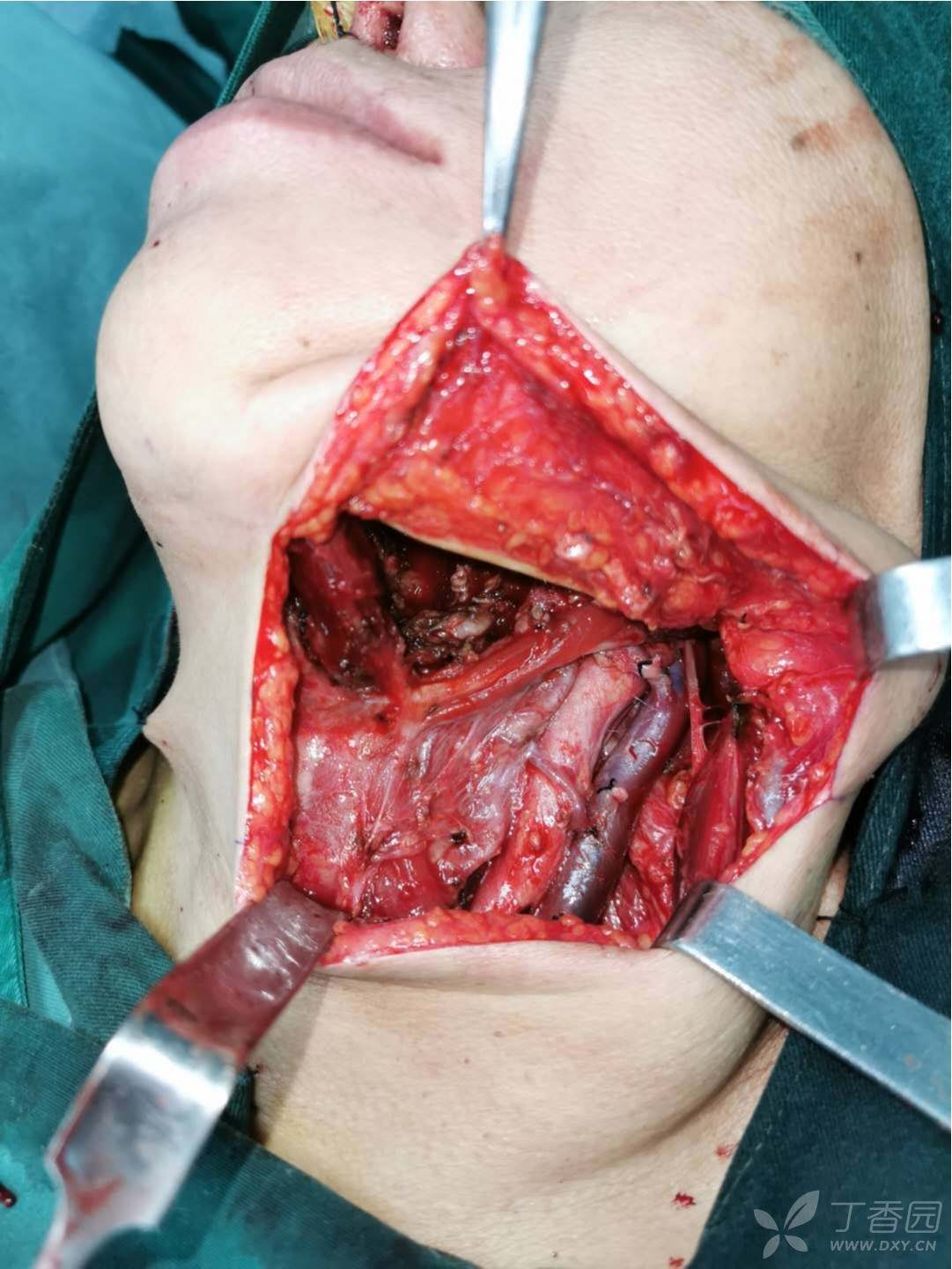 今天做的舌癌手术