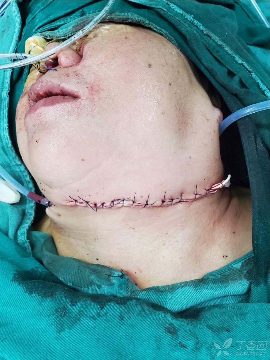 舌癌动完手术图片图片