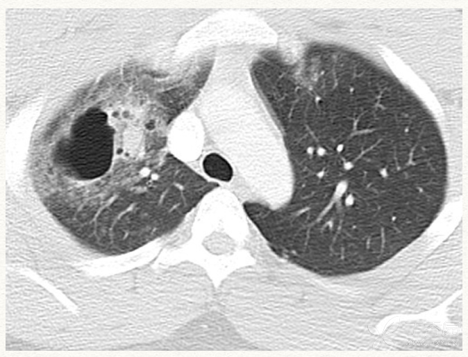 胸部ct研习社 空洞 与 气囊 如何界定 呼吸胸外 丁香园论坛