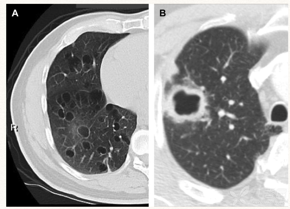 胸部ct研习社 空洞 与 气囊 如何界定 呼吸胸外 丁香园论坛
