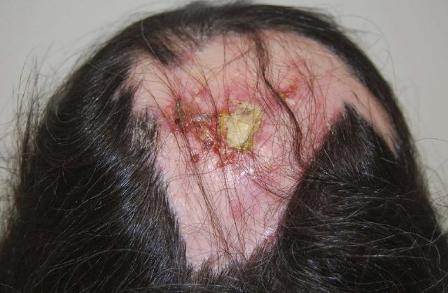 头皮损伤分类图片