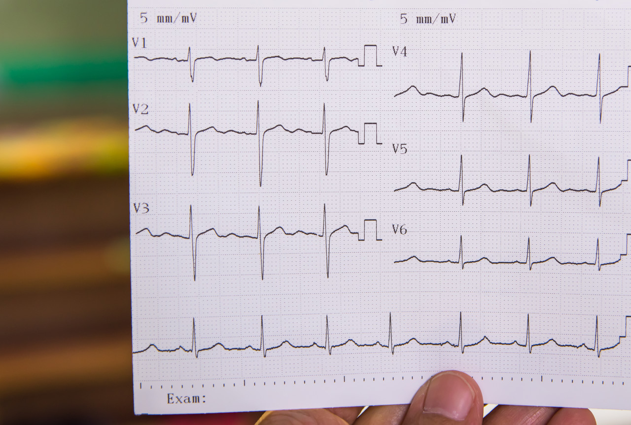 没有心脏病也有“异常”心电图？|器质性心脏病|心电图|心脏病|高血压|-健康界