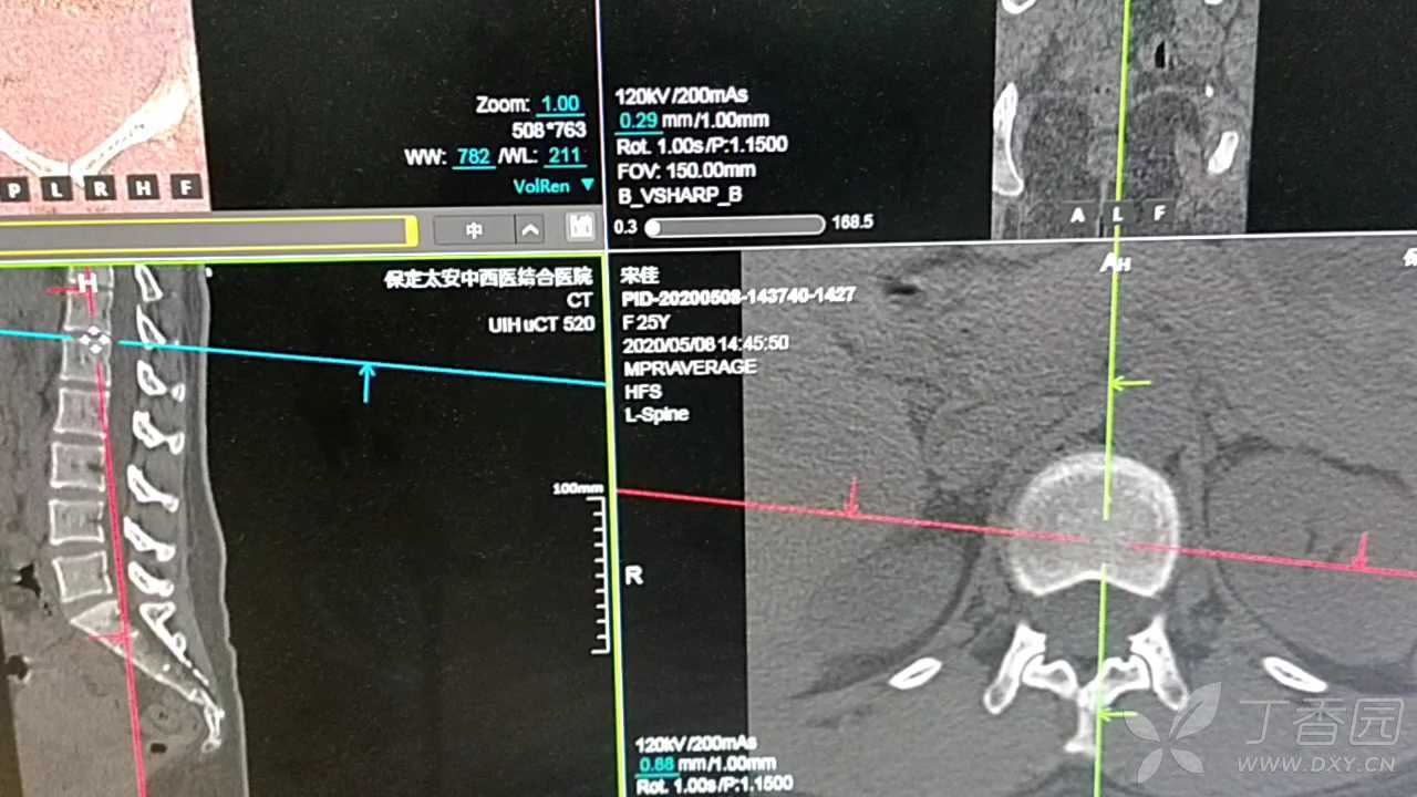 请看一下这个椎体内的低密度影,是正常的?