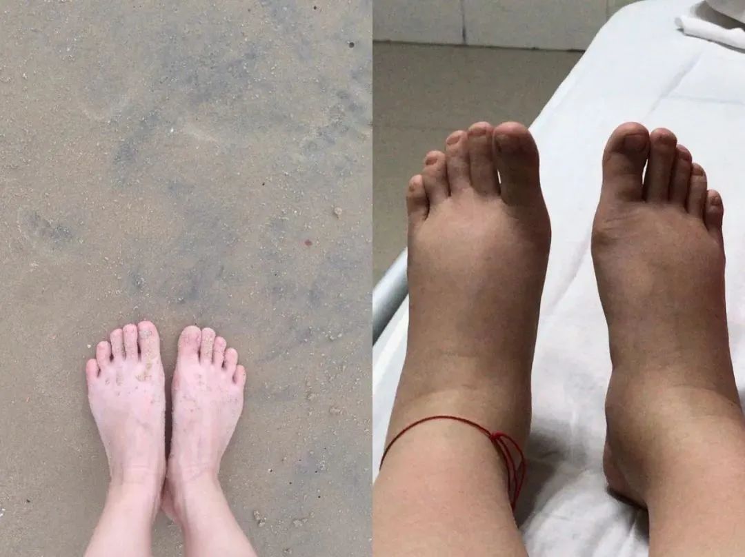 沈甜 2019 年生产前一天拍下了自己浮肿的脚(右),和 2017 年去旅游时