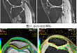 磁共振 3D-FS-DESS 序列联合 T2-mapping 及 T1ρ技术对关节软骨病损的临床应用