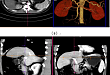 肝脏一体化成像（一次一体化扫描成像：肝脏平扫及增强、肝动脉 CTA、 门脉 CTAP、3D 可视化）