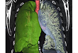 肺小结节后处理及 3D 打印技术的临床应用研究