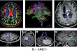 脑肿瘤术前 MRI 弥散张量成像评估及其临床意义