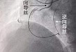 亚心医院成功应用逆向导丝技术治疗冠脉 CTO 病变