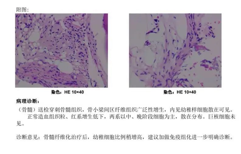 第三期蘆可替尼治療骨髓纖維化一例